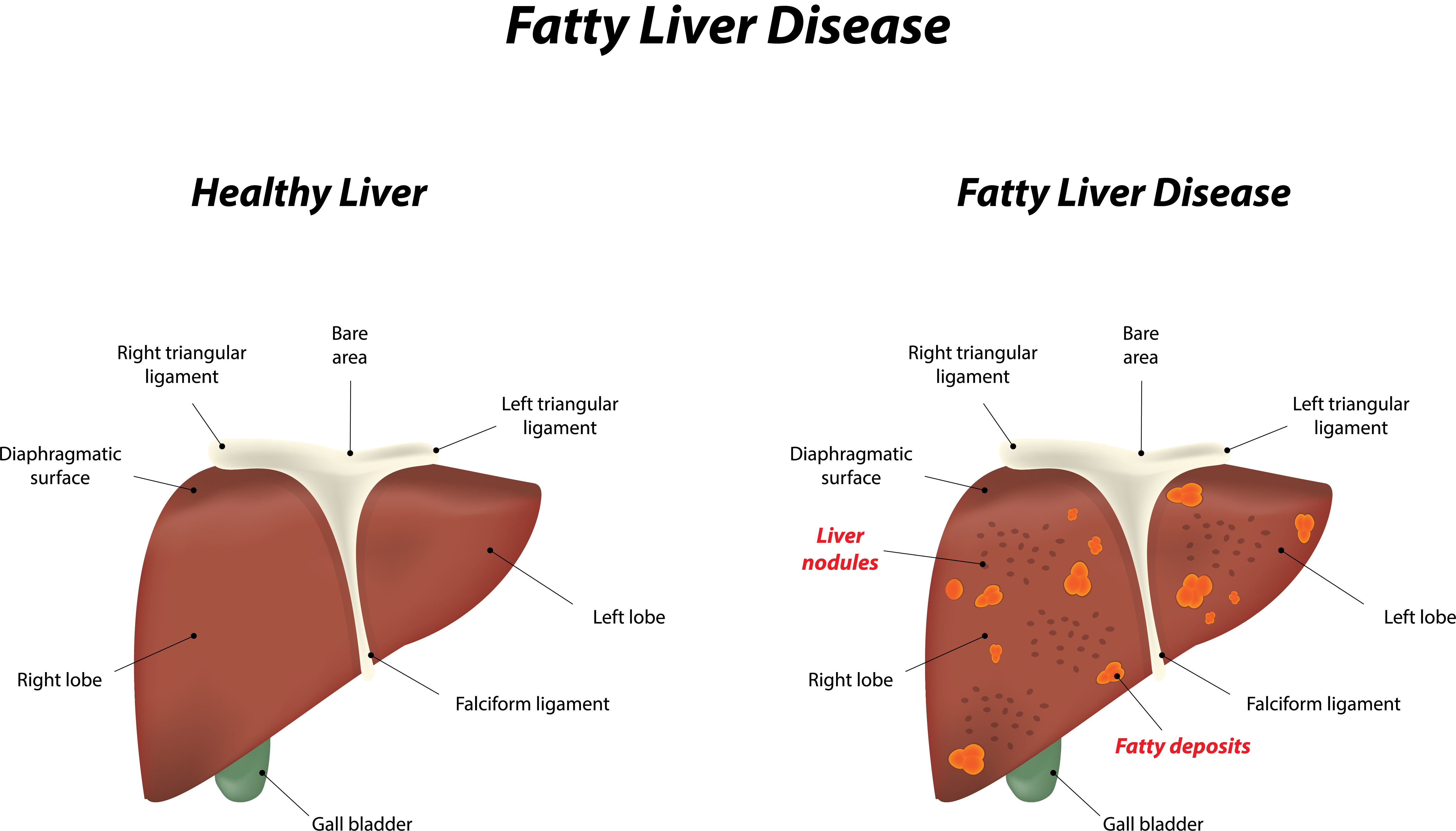 Nash Awareness Day Fatty Liver Q A With Physicians