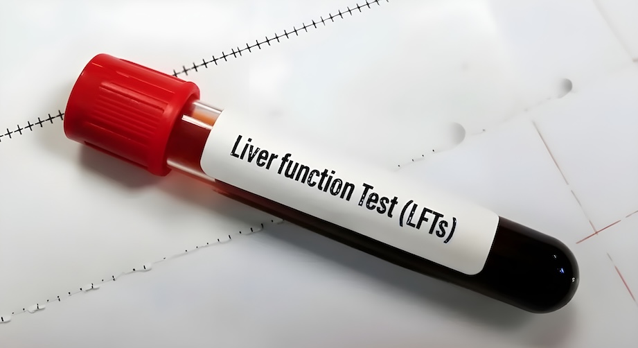 A vial full of blood for a blood sample labeled for liver function tests