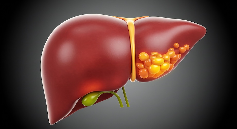 A digital rendering of a liver afflicted with fatty liver disease