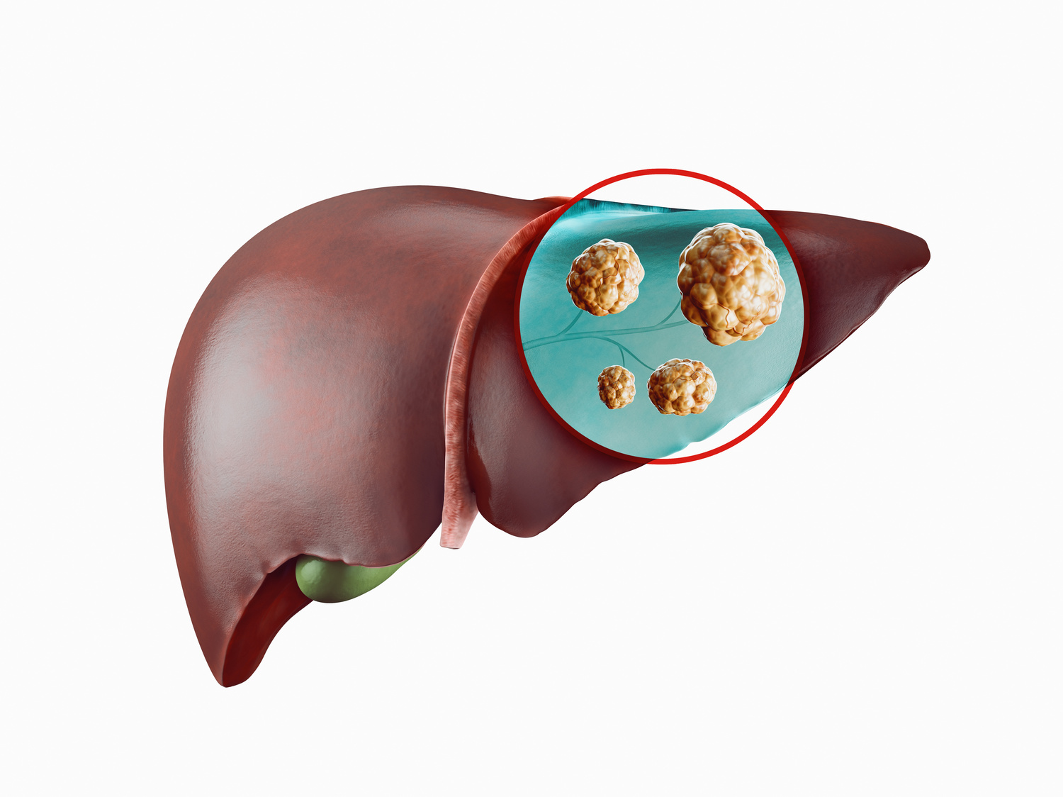 Picture of Liver highlighting Liver Cancer