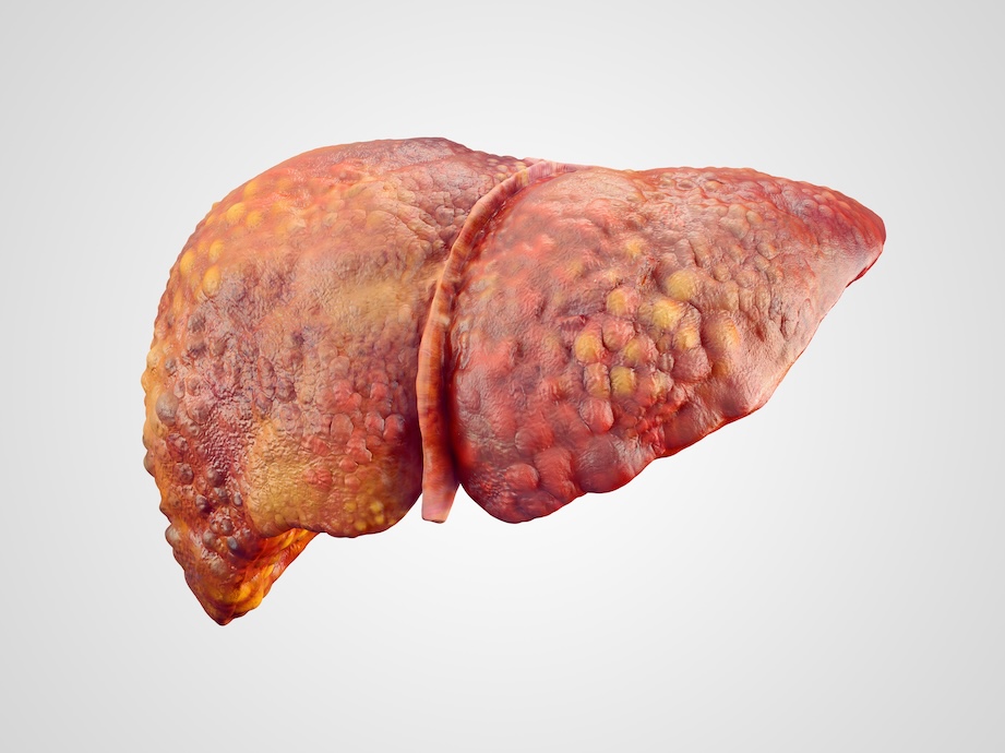 A digital rendering of a liver with cirrhosis