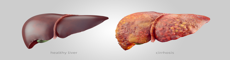 healthy vs cirrhotic liver