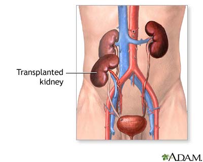Transplanted Kidney Diagram